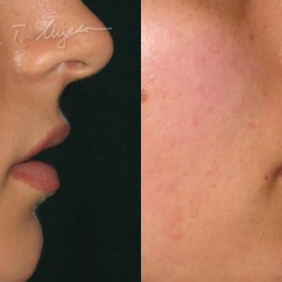 Marire Buze Acid Hialuronic 1