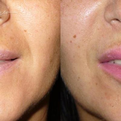 Marire Buze Acid Hialuronic 2