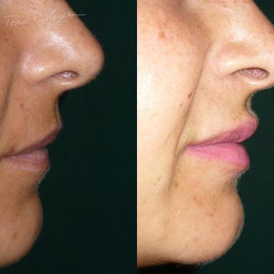 Marire Buze Acid Hialuronic 3