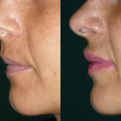 Marire Buze Acid Hialuronic 4