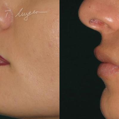 Marire Buze Acid Hialuronic