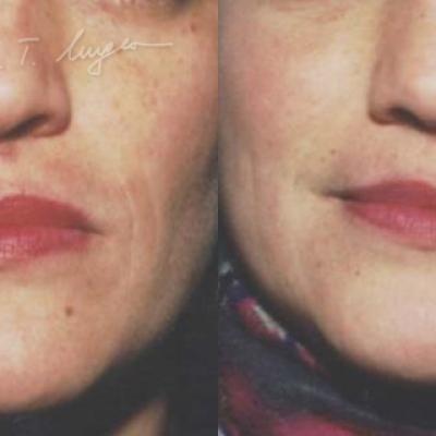 Adipo Implant Facial Adipolifting Cu Celule Stem 1