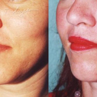 Adipo Implant Facial Adipolifting Cu Celule Stem 3