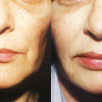 Adipo Implant Facial Adipolifting Cu Celule Stem 4