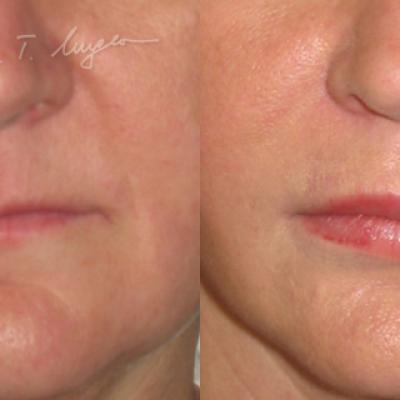 Adipo Implant Facial Adipolifting Cu Celule Stem