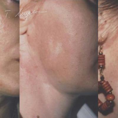 Adipo Implant Facial Reconstructie Regiunea Mandibulara