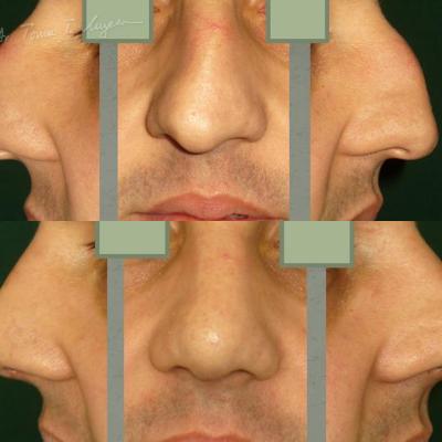 Rinoplastia Deviatia De Sept Cazul 10