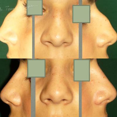 Rinoplastia Deviatia De Sept Cazul 1