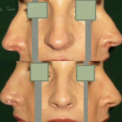 Rinoplastia Deviatia De Sept Cazul 2