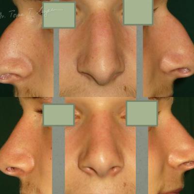 Rinoplastia Deviatia De Sept Cazul 3