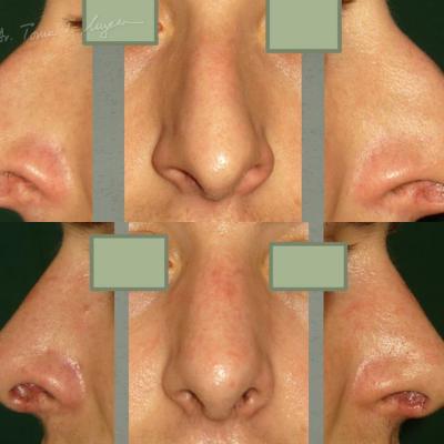 Rinoplastia Deviatia De Sept Cazul 4