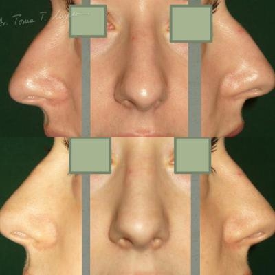 Rinoplastia Deviatia De Sept Cazul 5