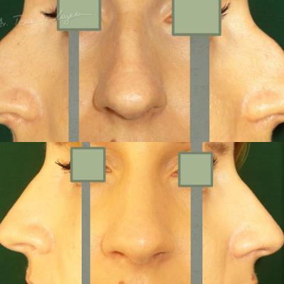 Rinoplastia Deviatia De Sept Cazul 6