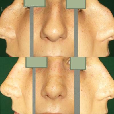 Rinoplastia Deviatia De Sept Cazul 7