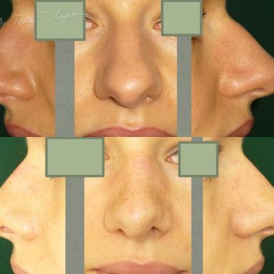 Rinoplastia Deviatia De Sept Cazul 8