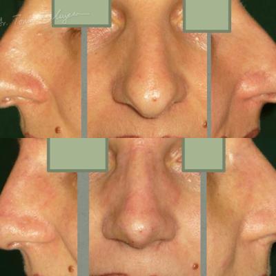 Rinoplastia Deviatia De Sept Cazul 9