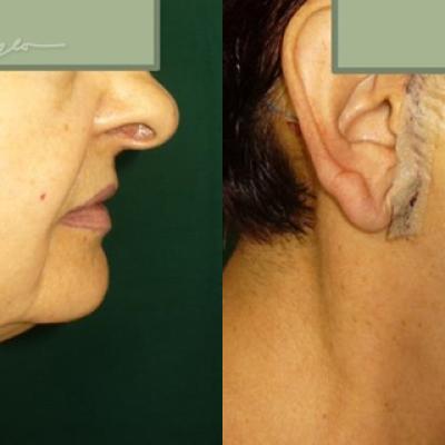 Lifting Cervico Facial 10