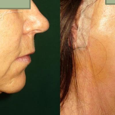 Lifting Cervico Facial 11
