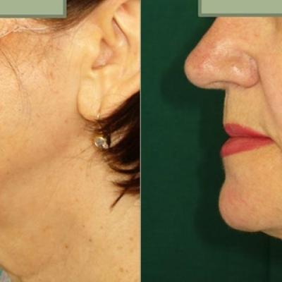 Lifting Cervico Facial 12