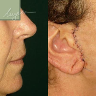 Lifting Cervico Facial 1