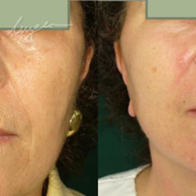 Lifting Cervico Facial 2