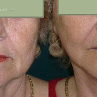 Lifting Cervico Facial 3