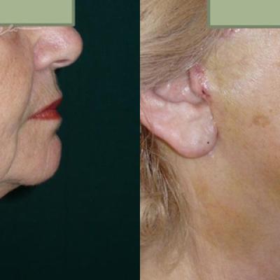 Lifting Cervico Facial 4