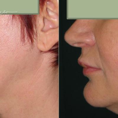 Lifting Cervico Facial 7