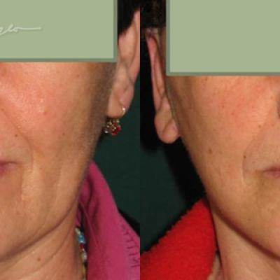Lifting Cervico Facial 8