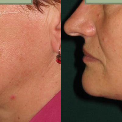 Lifting Cervico Facial 9