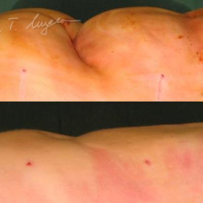 Infiltratie Tumescenta Sus Dupa Lipoaspiratie Jos