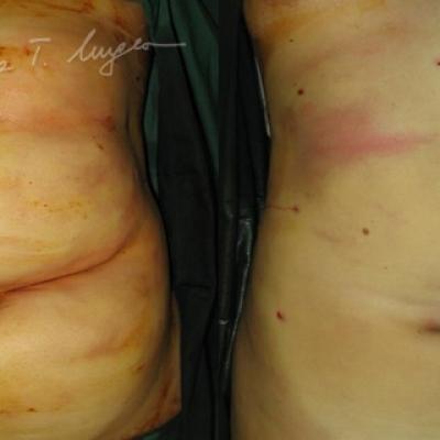 Infiltratie Tumescneta Stanga Dupa Lipoaspiratie Dreapta