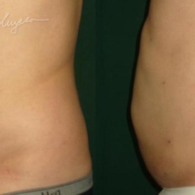 Lipoaspiratia Abdomen La 7 Zile 1