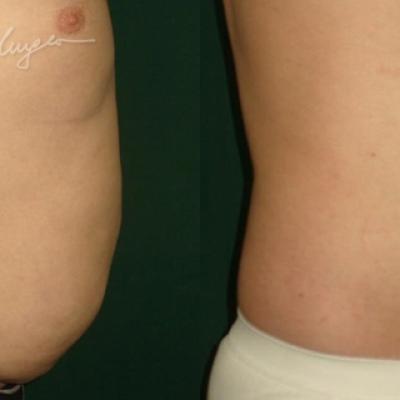 Lipoaspiratia Abdomen La 7 Zile 2