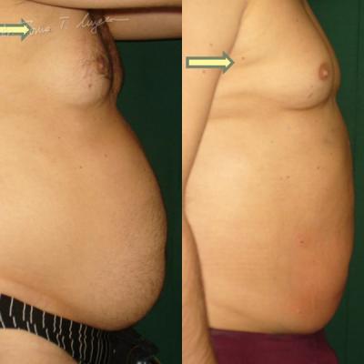 Lipoaspiratia Abdomen La 7 Zile 3