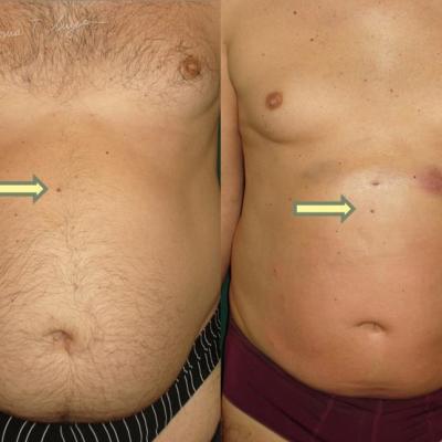 Lipoaspiratia Abdomen La 7 Zile 4