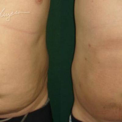Lipoaspiratia Abdomen La 7 Zile