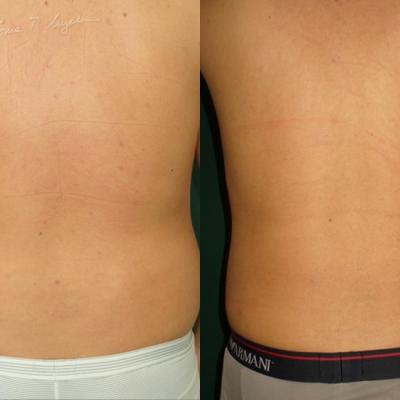 Lipoaspiratia Flancuri La 30 De Zile