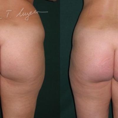 Lipoaspiratia Flancuri