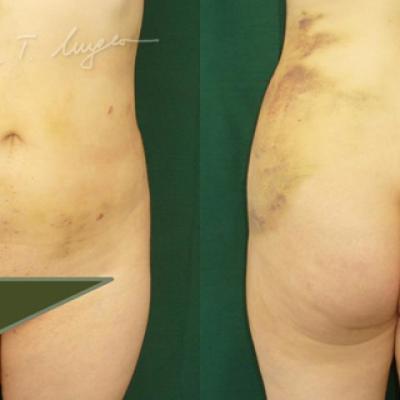 Lipoaspiratia La 24 Ore