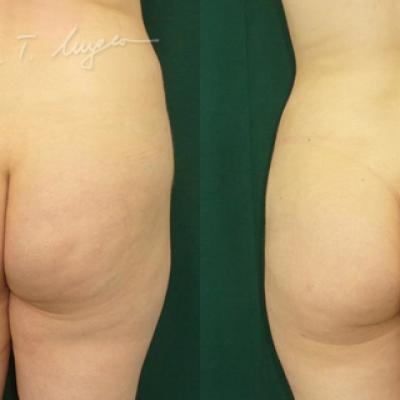 Lipoaspiratia La 30 Zile 1