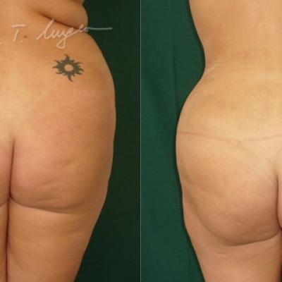 Lipoaspiratia La 30 Zile 3
