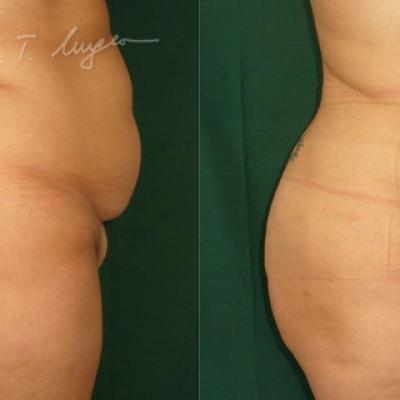Lipoaspiratia La 30 Zile 4
