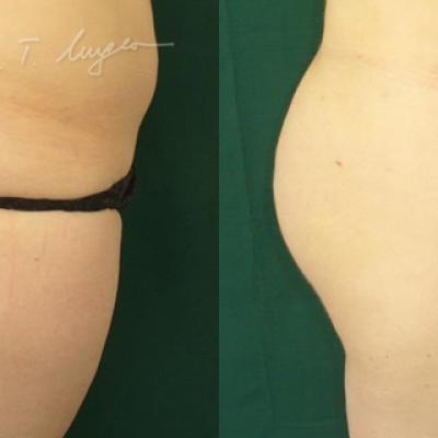 Lipoaspiratia La 30 Zile