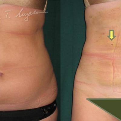 Lipoaspiratie Abdomen Si Flancuri La 24 Ore