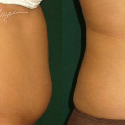 Lipoaspiratie Abdomen Si Flancuri La 30 De Zile