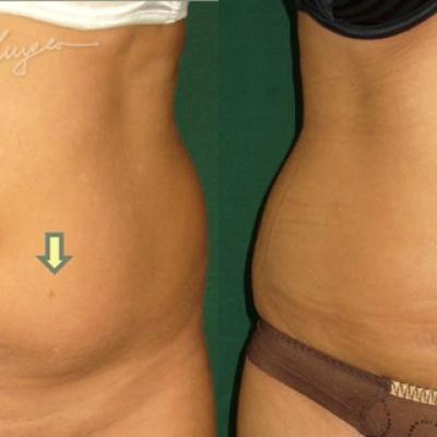 Lipoaspiratie Abdomen Si Flancuri La 30 Zile