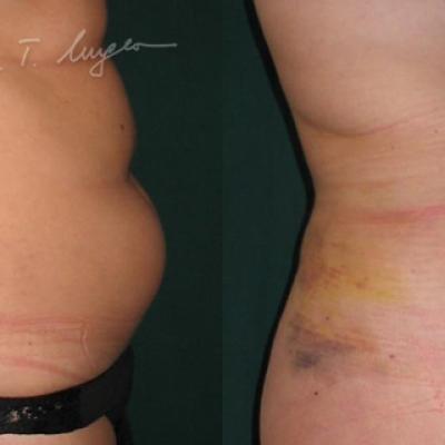 Lipoaspiratie Abdomen Si Flancuri