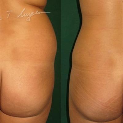 Lipoaspiratie Flancuri