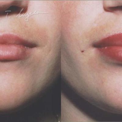 Marire Buze Adipoimplant 2